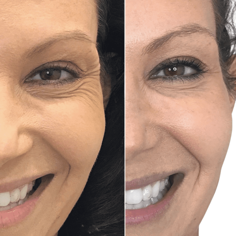 Before and After Botox Best Medspa Cincinnati West Chester