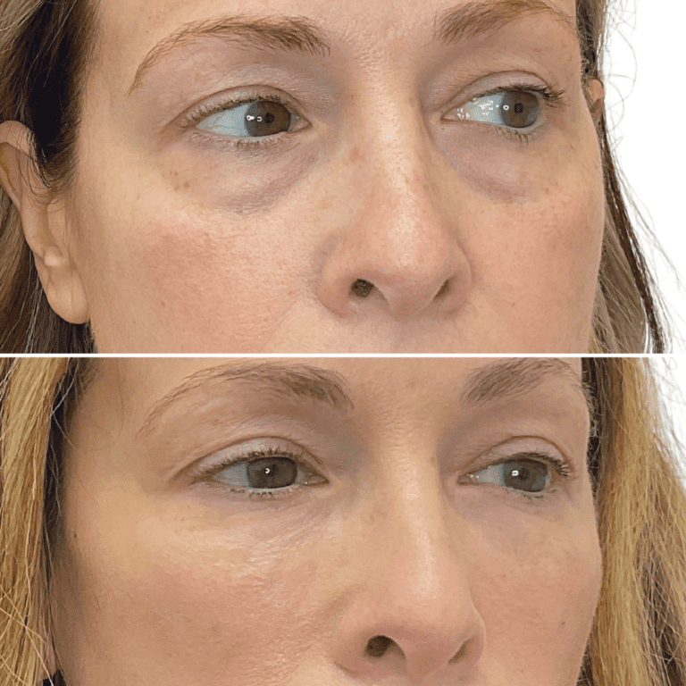 Under Eye Filler PRF Inertia Best Medspa Near Me Cincinnati West Chester Ohio